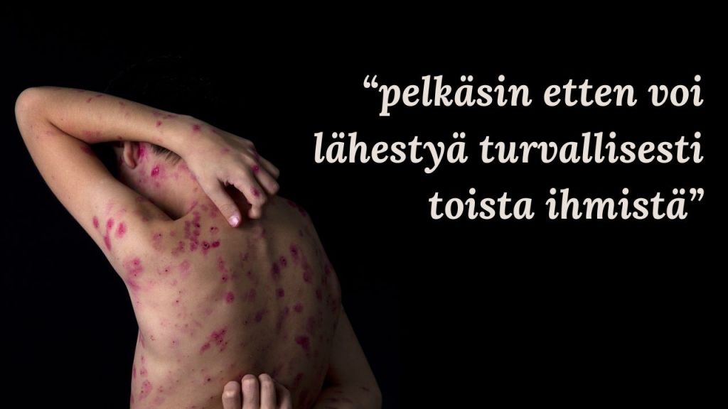 syyhy luonnollinen hoito